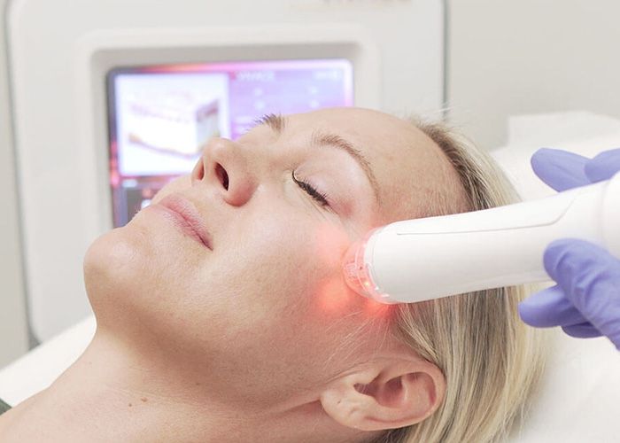 Microneedling Radiofrequency (MNRF)