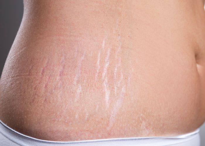 Treatment of Stretch marks